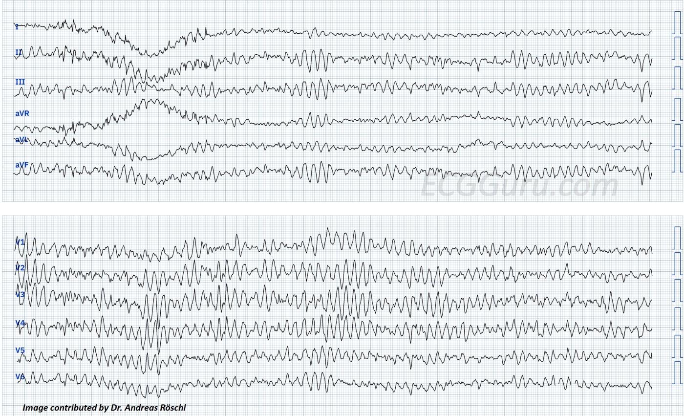 ECG Basics Ventricular Fibrillation Seen In Twelve Leads ECG Guru Instructor Resources